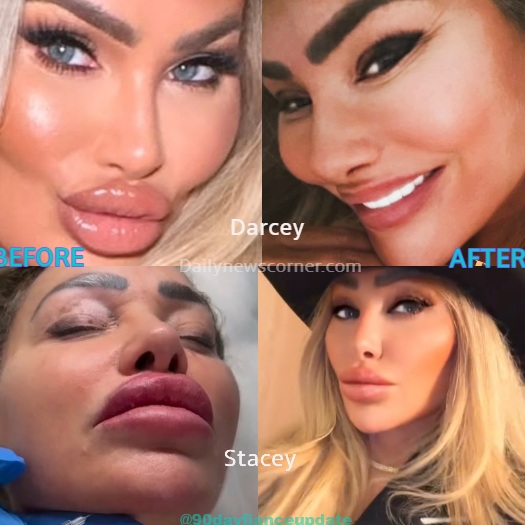 Darcey Silva - Stacey Silva - Before and After lip filler removal - Instagram